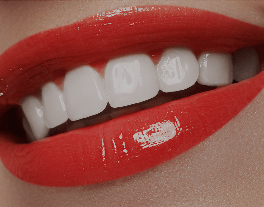 SnapOn Veneers The Ultimate Guide 2023 NatruSmile