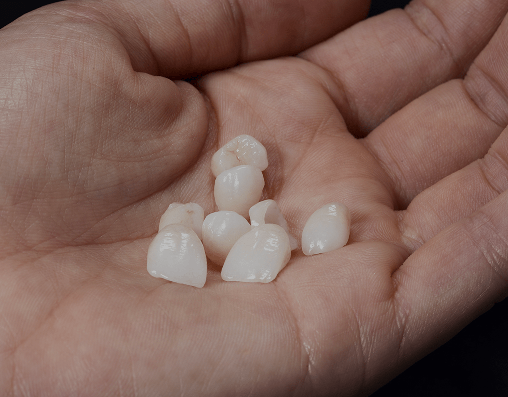 Temporary Veneers Benefits, Costs, And Results NatruSmile