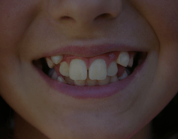 What Causes Buck Teeth And How To Get Rid Of It – NatruSmile
