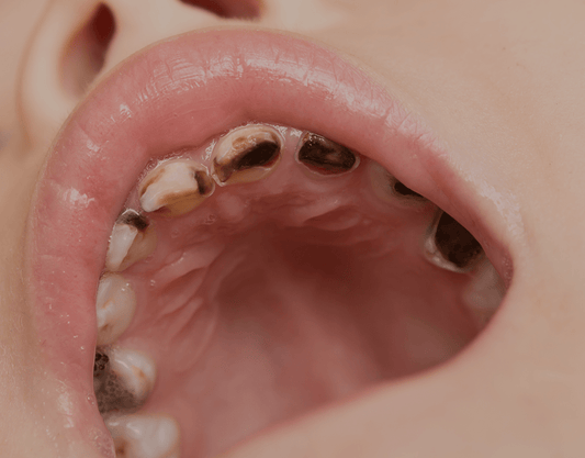 Black Teeth: Symptoms, Causes, and Treatment
