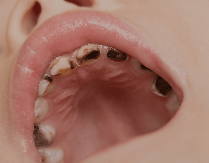 Black Teeth Symptoms Causes Treatment 2023 Guide NatruSmile black-teeth-symptoms-causes-treatment-2023-guide-natrusmile