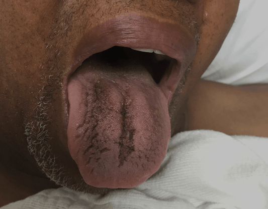 Black Tongue: Causes, Treatments, and Proven Remedies