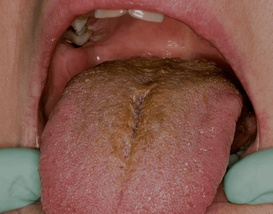 Brown Tongue: Symptoms, Causes & Treatment