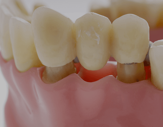 Cantilever Dental Bridge: Benefits, Drawbacks, and More