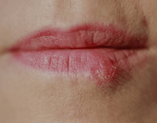 Cold Sores: Causes, Treatment, & Prevention