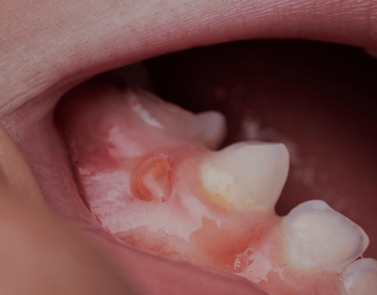 Gum Boils: Causes, Categorization, Symptoms, and Treatment
