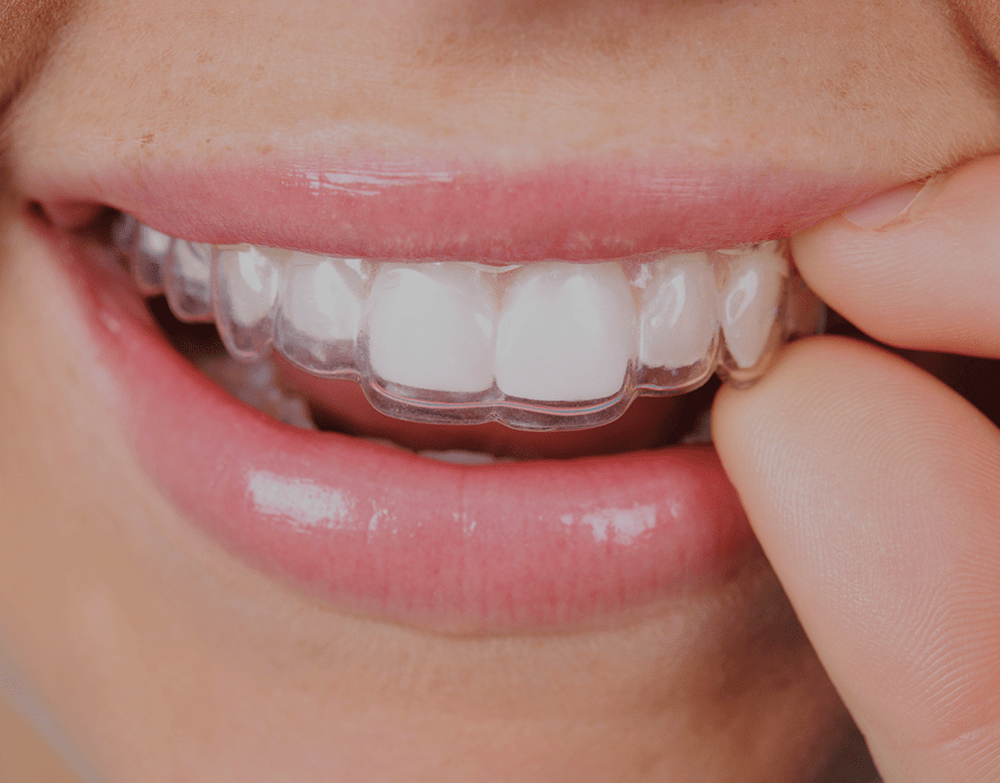 Essix Retainer Cost, Care, Benefits, How It Works NatruSmile