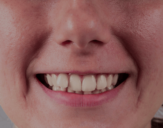 Crossbite: Definition, Pictures, Causes, and Treatment