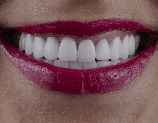 Dental Bonding: What is Teeth Bonding & What to Expect