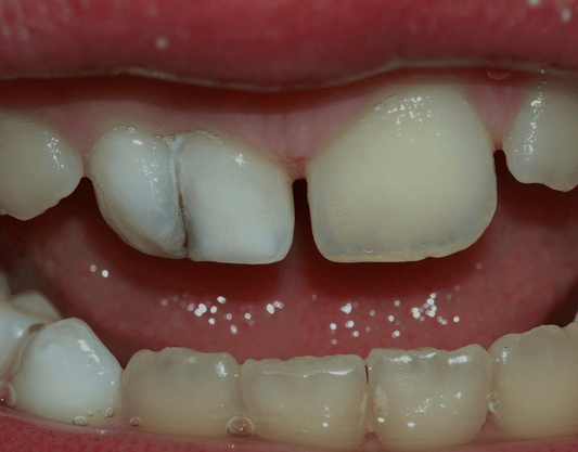 Tooth Gemination Causes and Treatments