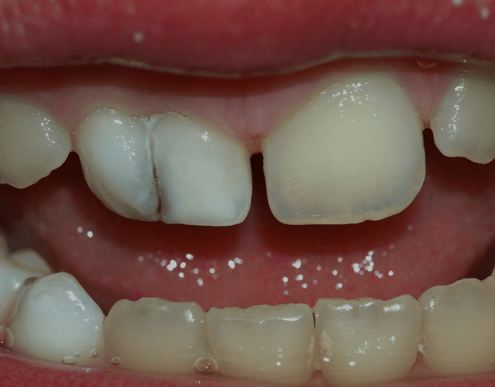 Tooth Gemination Causes And Treatments – NatruSmile