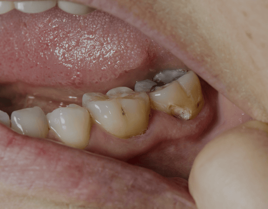 Dead Teeth: Signs, Treatment, Pain Management, And More