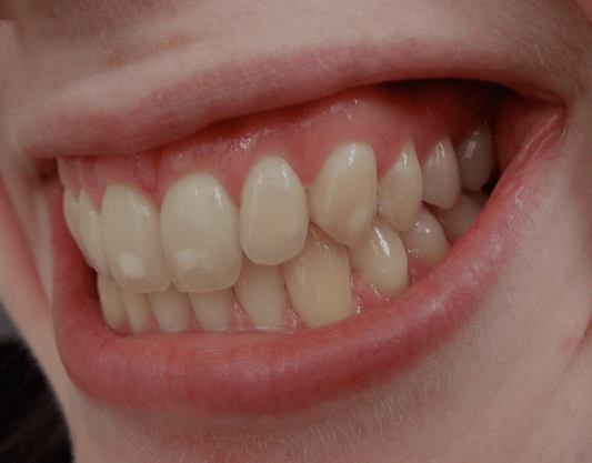 White Spots On Teeth: Causes, Treatment, And Prevention