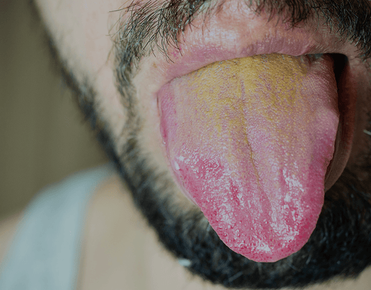 Yellow Tongue: Causes And How To Get Rid Of It