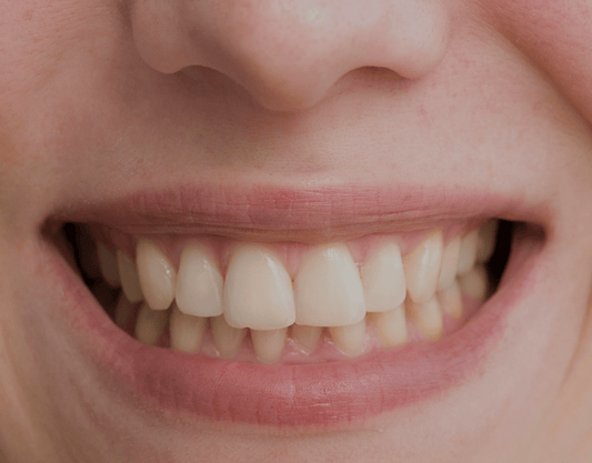 Why Your Teeth Whitening Treatments Aren't Working