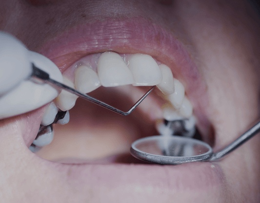 Will Teeth Whitening Work With Dental Fillings?