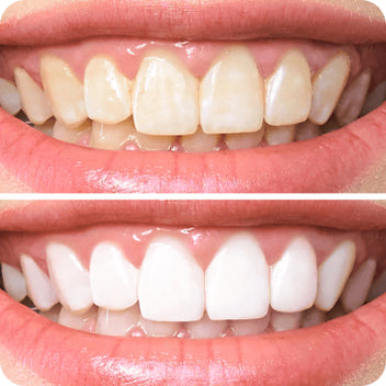 Translucent In Teeth Normal Translucent Teeth: Learn The Causes And Fixes – NatruSmile